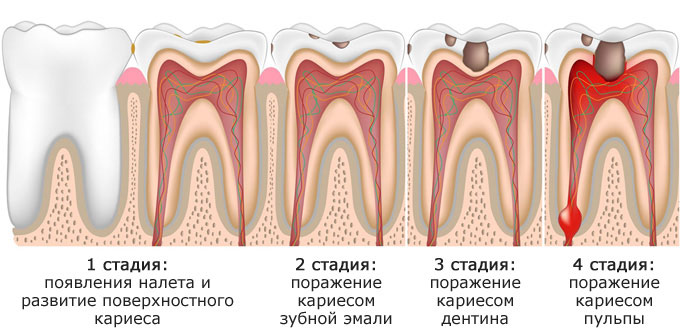 Почему появляется кариес